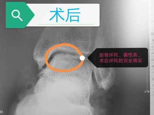 距骨术后可以吃生姜吗（距骨手术后注意事项）-图3