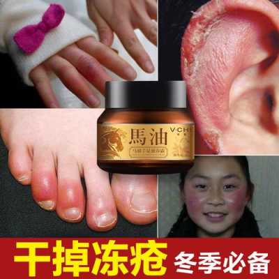 生姜耳朵冻疮（生姜耳朵冻疮可以用吗）-图1