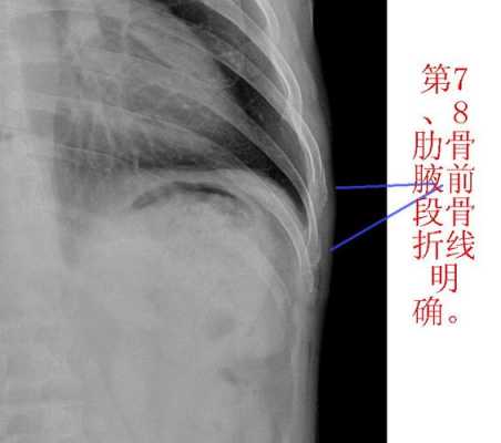 肋骨骨折能不能吃生姜片（肋骨骨折能不能吃生姜片泡水）-图2