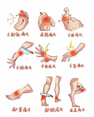 痛风似生姜的简单介绍