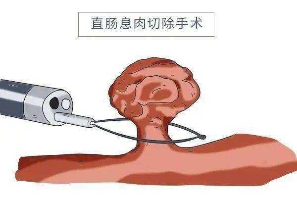 肠息肉患者能吃腌生姜吗-图1